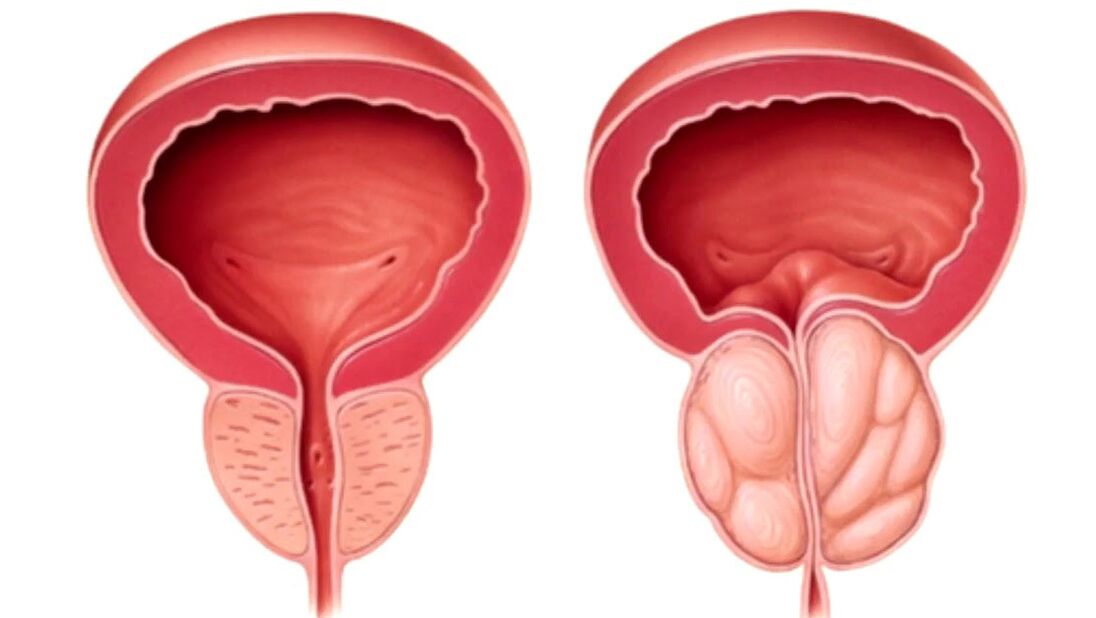 zdravá a chorá prostata