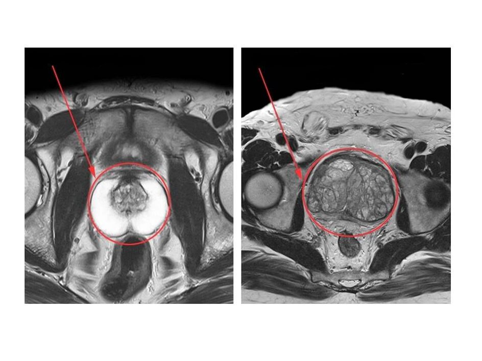 Porovnanie zdravej (vľavo) a zapálenej (vpravo) prostaty na snímkach MRI